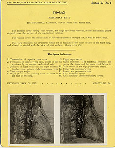 Thumbnail of Stereoscope Cards, Edinburgh Anatomy: Mediastina, Lungs, Upper Limb - Thorax, Mediastina - No. 3. (2009.10.0002F)