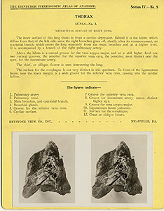 Thumbnail of Stereoscope Cards, Edinburgh Anatomy: Mediastina, Lungs, Upper Limb - Thorax, Lungs - No. 3. (2009.10.0002L)