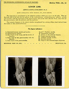 Thumbnail of Stereoscope Cards, Edinburgh Anatomy: Lower Limb Continued - Lower Limb, Articulations, Knee-Joint - No. 3. (2009.10.0003M)