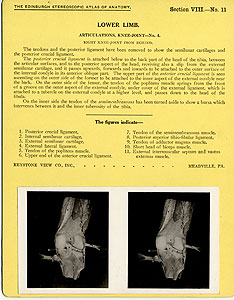 Thumbnail of Stereoscope Cards, Edinburgh Anatomy: Lower Limb Continued - Lower Limb, Articulations, Knee-Joint - No. 4. (2009.10.0003N)
