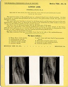 Thumbnail of Stereoscope Cards, Edinburgh Anatomy: Lower Limb Continued - Lower Limb, Popliteal Space - No. 2. (2009.10.0003Q)