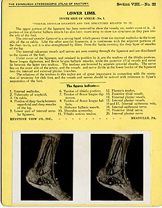 Thumbnail of Stereoscope Cards, Edinburgh Anatomy: Lower Limb Continued - Lower Limb, Inner Side of Ankle - No. 1. (2009.10.0003Y)