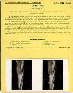 Thumbnail of Stereoscope Cards, Edinburgh Anatomy: Lower Limb Continued - Lower Limb, Back of Leg - No. 1. (2009.10.0003Z)